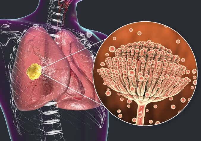 A Digital Illustration of How Mold Affects Health